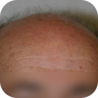 Antes y despues 1 - microinjerto