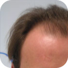Antes y despues 2 - microinjerto