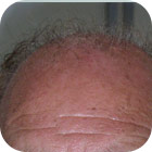 Antes y despues 4 - microinjerto