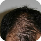 Antes y despues 5 - microinjerto