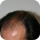 Antes y despues 6 - microinjerto